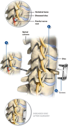 Anterior Cervical Discectomy & Fusion Surgery - Sydney, NSW